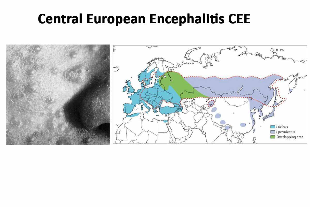 Central European Encephalitis CEE