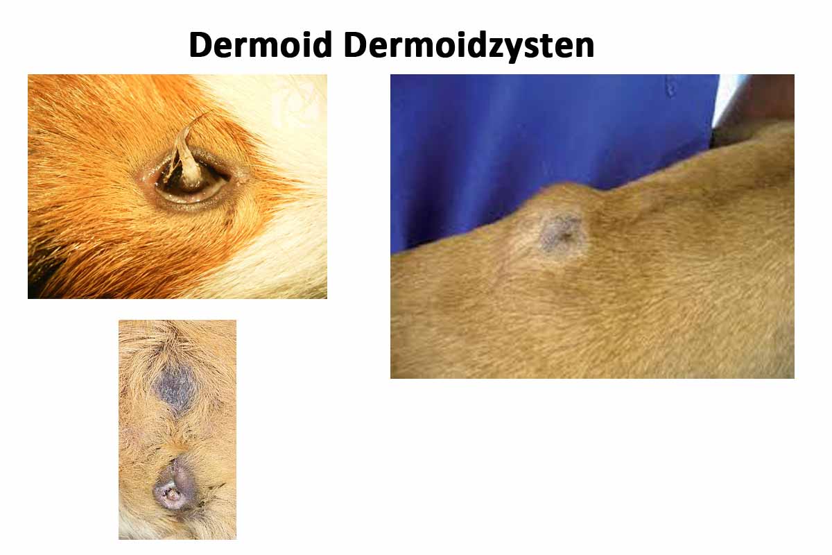 Dermoid Dermoidzysten