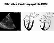 Dilatative Kardiomyopathie DCM beim hund
