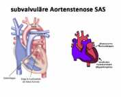 Subvalvuläre Aortenstenose SAS